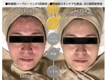 ラセンシアアンジュ(Lasencia Ange)の写真/【天神西通りすぐ◎】完全個室のプライベート空間で本格施術をご提供♪くすみ/シミしわ改善/毛穴悩みに★