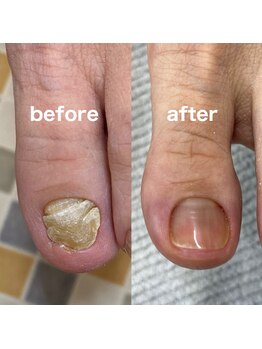肥厚爪ケア