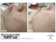 ビュール(VIERU)の雰囲気（光フェイシャル☆ニキビケア/美肌　お試しショット打ち¥3000~）