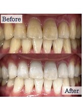 LBSホワイトニング 錦糸町店/ホワイトニングビフォーアフター