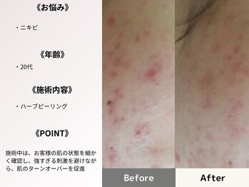 ルディラ 大宮店/ハーブピーリング