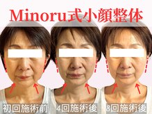 フレキシボディ(FlexiBody)/小顔施術ビフォーアフター #3