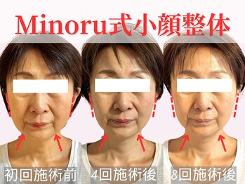 フレキシボディ(FlexiBody)/小顔施術ビフォーアフター #3