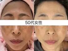 シミケア専門店 SAKURA 平塚店/平塚シミケア/伊勢店シミケア