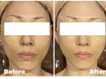 ブルーム(BLOOM)/WISHpro ビフォーアフター