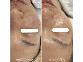 ルーナ 恵比寿(Luna)/ふわもちツヤ肌フェイスワックス