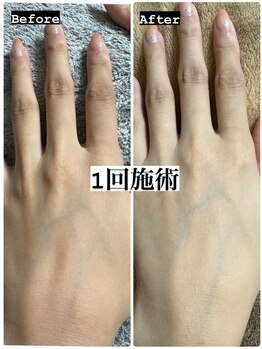 リノ(Lino)/美白/くすみ/毛穴◎おててパック