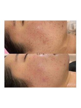 トータルビューティーサロンリア(Li'a)/ビフォーアフター