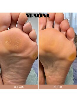 マオヌー(MAONU)/韓国式足裏角質ケア　症例写真