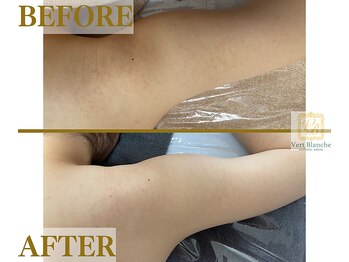 ヴェールブランシュ 町田(Vert Blanche)/#ブライダルエステ#痩身#二の腕