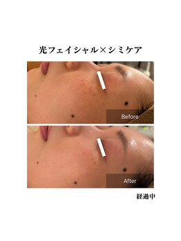エムドット プラス(M DOT +)/シミケア×最新光フェイシャル