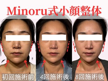 フレキシボディ(FlexiBody)/小顔施術ビフォーアフター #4