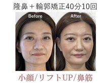 ラプリ 梅田店(Raplit)/隆鼻＋輪郭矯正40分10回