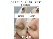 ティアム バイ テトテ 神戸三宮(TIAM by tetote)/ハイドラ＋ハーブ＋美容液導入