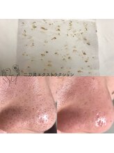 毛穴ケアサロン そらな/毛穴洗浄エクストラクション☆