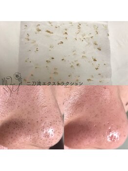 毛穴ケアサロン そらな/毛穴洗浄エクストラクション☆