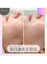 セカンドフロア バイ ブレスト ハコダテ(2nd floor by BLESSED HKD)/ターンオーバーを正常化