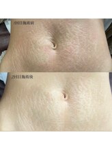 ウルル(ULuLu)/妊娠線無くしたい方必見！