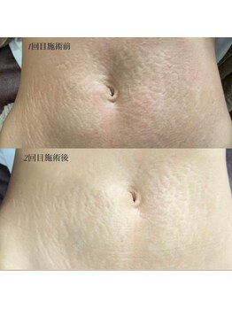 ウルル(ULuLu)/妊娠線無くしたい方必見!