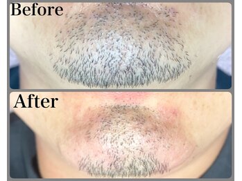 トータルメンズエステ キング(KING)/■電気脱毛■一回で処理完了