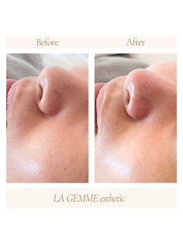 ラジェム(LA GEMME)/人気のハーブピーリング