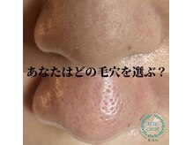 ビビ(VIVI)/毛穴ケアにララピーリング