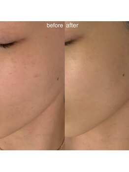 シエル(Ciel)/フェイシャル★シミ改善