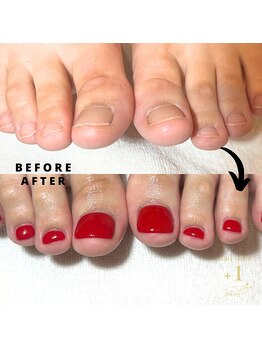 プラスワン(+1)/フット深爪矯正