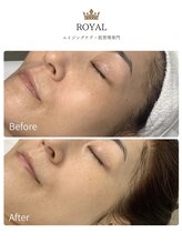 ロイヤル(ROYAL)/VVSダイヤモンドピーリング
