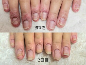 グレースレディ 大阪店/深爪/自爪育成/フィルイン