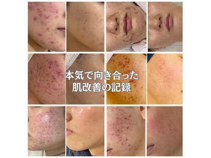 ハクビューティー(HAKU BEAUTY)の写真