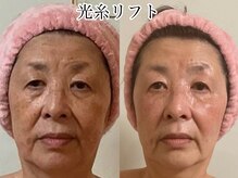 メディカルサロン レムリアの雰囲気（光糸リフト！目の下たるみ頬のたるみ改善諦めないで！）
