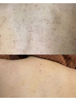 ステラ(Stella)の写真/背中のニキビやざらつき改善をされたい方