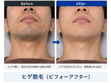 メンズラボ 京都駅前店/清潔感と時短を叶えるヒゲ脱毛