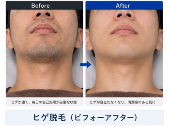 メンズラボ 京都駅前店/清潔感と時短を叶えるヒゲ脱毛
