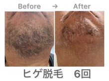 ナルシス/【脱毛】6回の変化★