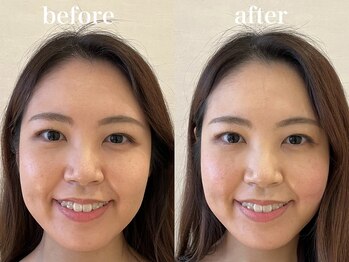 ハリノヒ 大阪院/美容鍼でエラ張り・たるみ改善