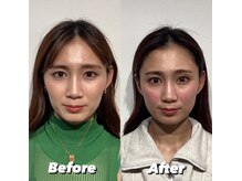 コルミチョン サロン(骨美整 salon)/コケ改善施術　Before・After &nbsp;