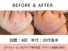 ア クーユ 相模大野店/ハーブピーリング/ニキビケア