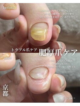 アイル(isle)/【肥厚爪でお悩み】のお客様