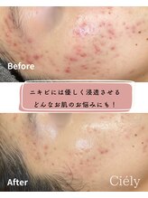 シエリー 原宿本店(Ciely) お肌の悩み 全て改善♪