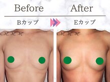 メディカルサロン エム エム エム 大阪梅田グランドサロン(M.M.M)/【バストアップ例】　B→Dカップ