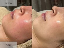 シェリーミル(Cherie Miru)の雰囲気(クリスティーナ/REVI/HAAB REPROハーブピーリングで肌質改善)