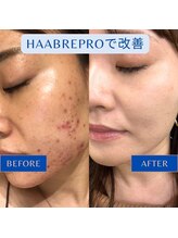 リツイート(ReTweet)/ハーブピーリング・艶・くすみ