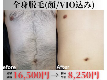 アップパイン(UPPINE)/全身脱毛(顔・VIO込み)¥8,250円
