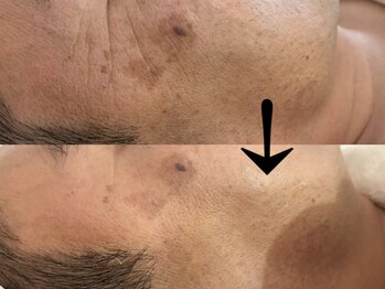 サロン ドロップ 上小田井(Salon drop)/「シミ改善」途中経過