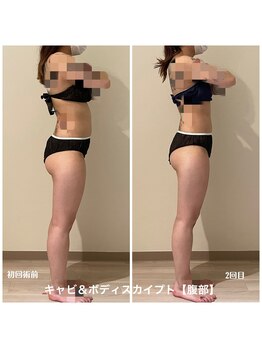 ヒーリングサプリ(Healing Supple)/ぽっこりお腹が引き締る