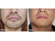 ララリア(LaLaLia)/ひげ　ビフォーアフター