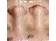 グレアージュ(GLEAGE)/ハーブピーリングで肌質改善！