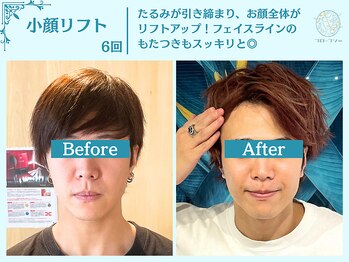 フローフシ∞/【小顔】切らない小顔リフト